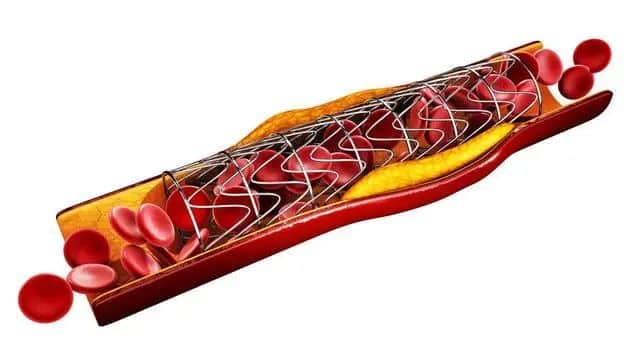 Cardiac-stent