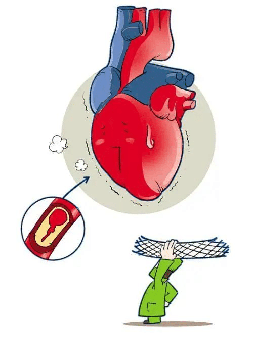 heart stent implantation