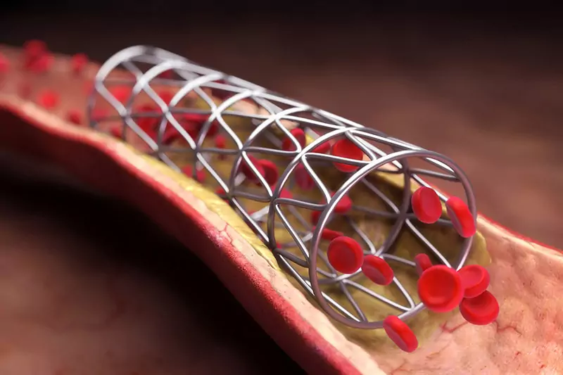 laser cutting stents