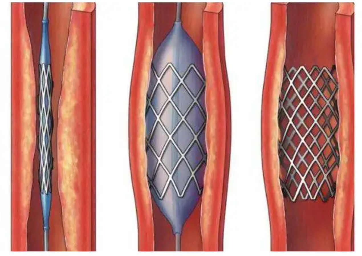 Application of laser cutting in medical stent