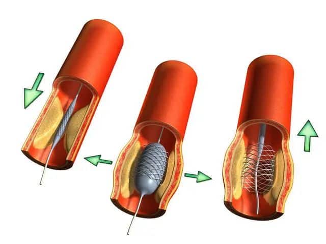 What are the advantages of drug eluting stents?