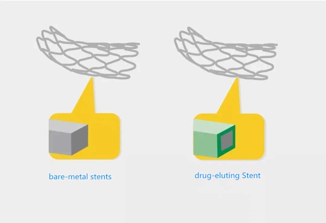 What are the four stages in the development of cardiac stents？