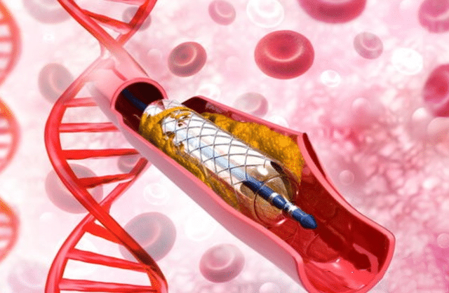 Heart stent
