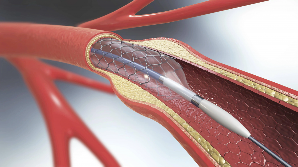 Cardiac Stent Market with Huge Potential — China-stent cutting,laser stent cutter,Menlaser is medical stent,coronary stent,heart stent cutting machine from China