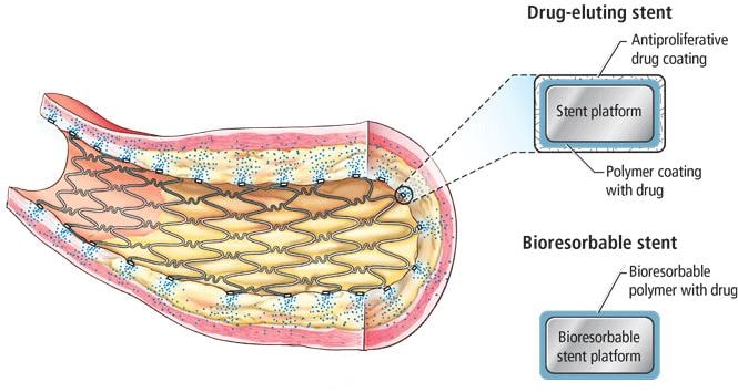 What is a bioabsorbable stent ？