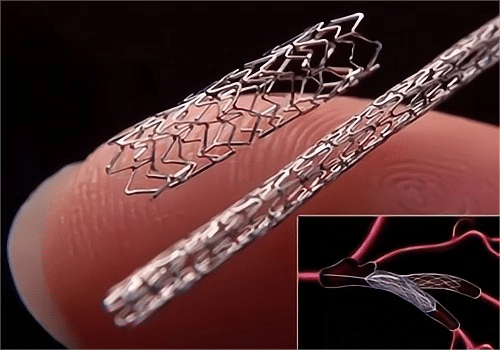 Coronary stent laser cutting advantages