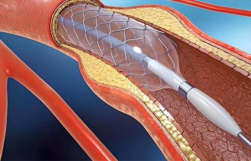 Detailed explanation of the process requirements of laser cutting machine in stent cutting