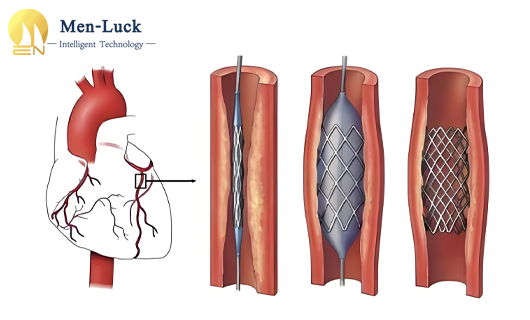 The advantages of femtosecond laser cutting machine in the processing of PTCA coronary balloon catheter