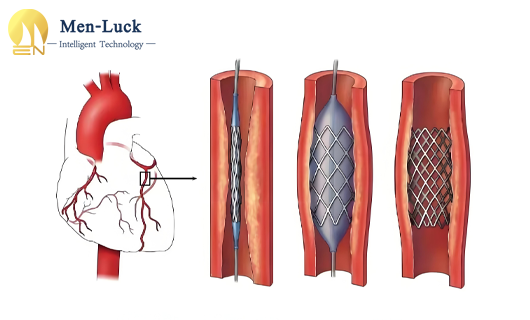 Precision innovation of laser cutting machine in heart stent manufacturing